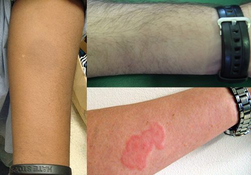 three picture of bed bug bites on people's arms