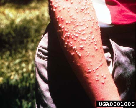 Figure 2, A person's arm with dozens of fire ant stings.