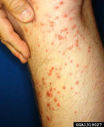 Figure 3, A person's leg with numerous pustules formed after being stung by fire ants. 